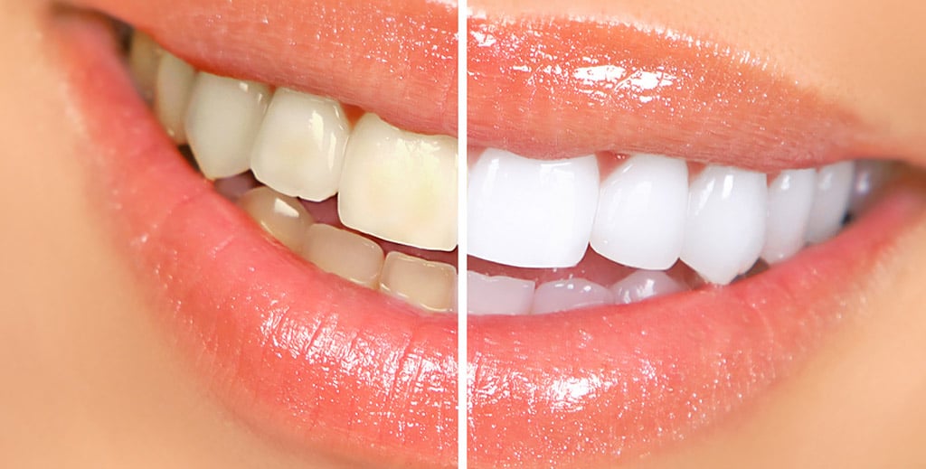 teeth whitening teeth whitening