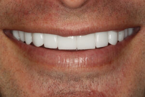 After Image: Veneers