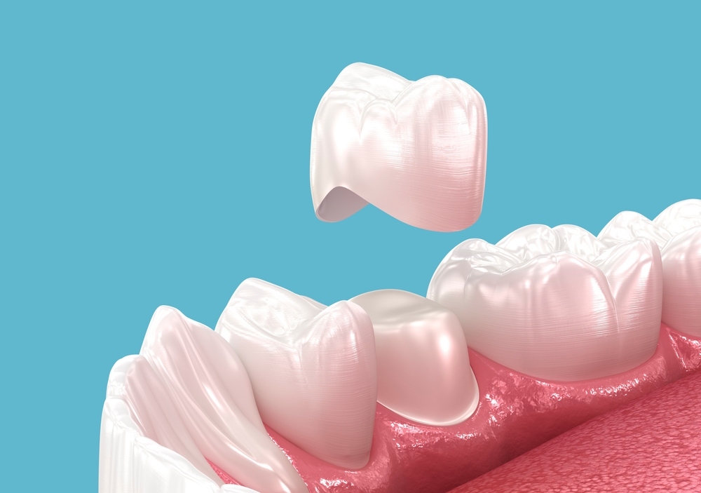 Close up illustration of a porcelain dental crown being placed over a damaged tooth.