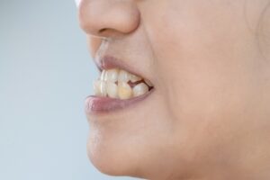 Close up of the profile of a woman's mouth with an underbite, in need of restorative dentistry