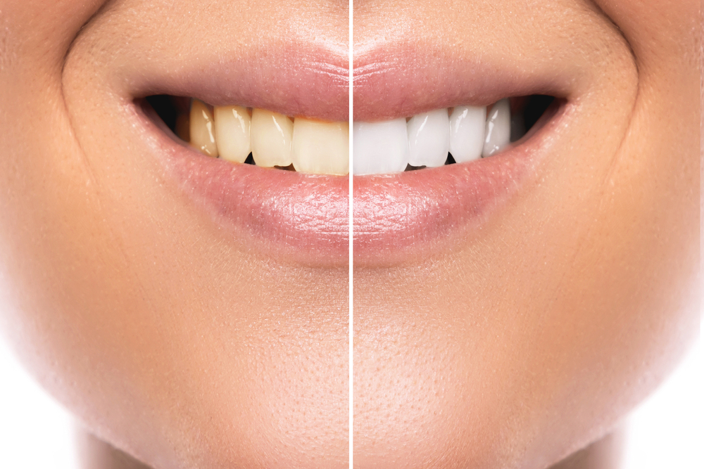 Close up before and after shots of a woman smiling, showing the progress of her teeth whitening treatment