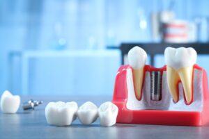 Educational models of teeth with dental implants and a dental bridge to repair cosmetic issues.