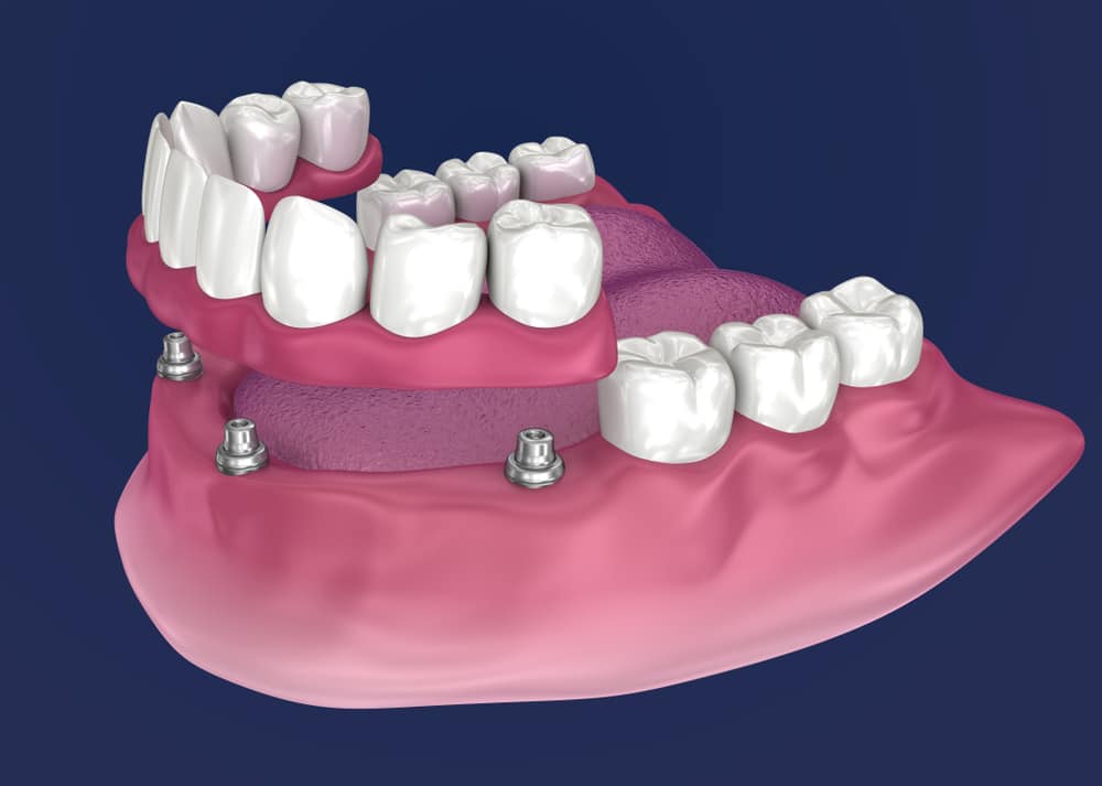 Graphic of a partial denture apparatus being applied to the mouth.