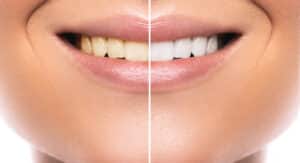 Close up of a young smiling woman's teeth before and after receiving professional whitening treatment.